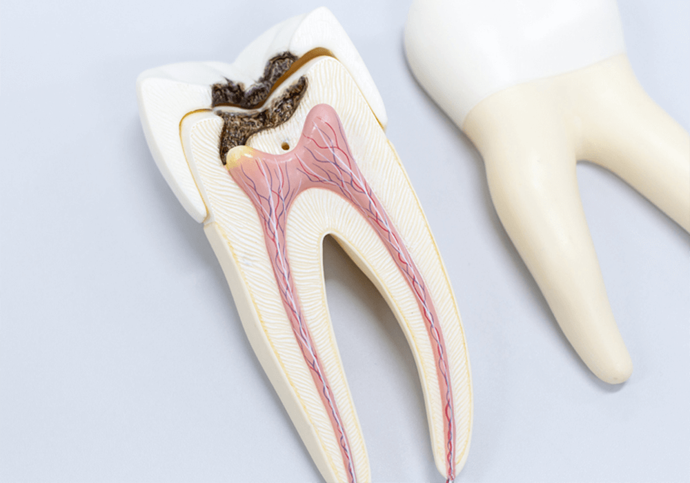 Лечение зубных каналов